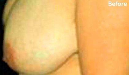 Breast Reduction Before & After Patient #2346