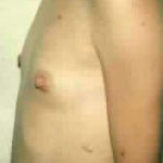Breast Augmentation Before & After Patient #2236