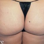 Buttock Augmentation Before & After Patient #2429