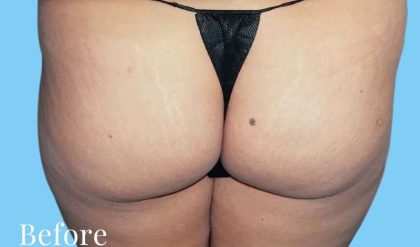 Buttock Augmentation Before & After Patient #2429