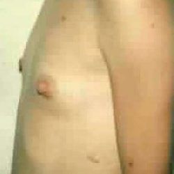 Breast Augmentation Before & After Patient #2236