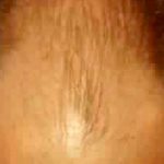 Hair Restoration Before & After Patient #2778