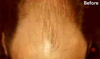 Hair Restoration Before & After Patient #2778