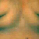 Liposuction Before & After Patient #2861