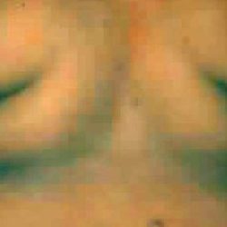 Liposuction Before & After Patient #2861