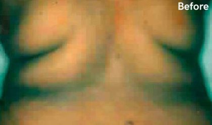 Liposuction Before & After Patient #2861