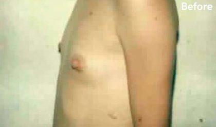 Breast Augmentation Before & After Patient #2236