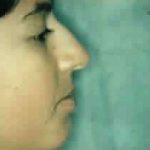 Rhinoplasty Before & After Patient #2985