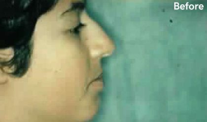 Rhinoplasty Before & After Patient #2985