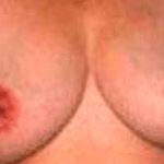 Breast Reduction Before & After Patient #2346