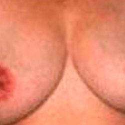 Breast Reduction Before & After Patient #2346
