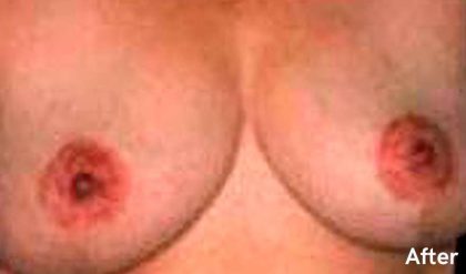 Breast Reduction Before & After Patient #2346
