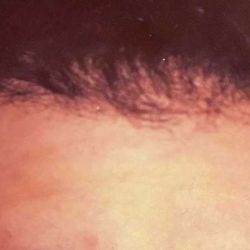 Hair Restoration Before & After Patient #2781