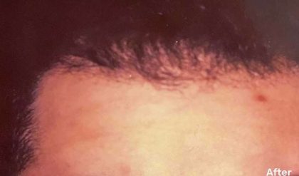 Hair Restoration Before & After Patient #2781