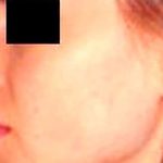 Rhinoplasty Before & After Patient #2988