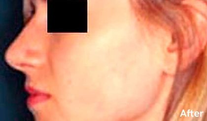 Rhinoplasty Before & After Patient #2988