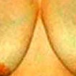 Breast Reduction Before & After Patient #2346