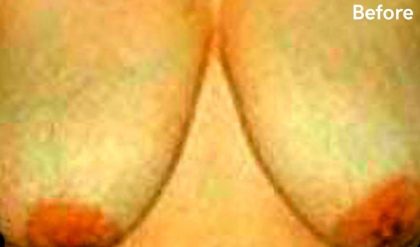 Breast Reduction Before & After Patient #2346