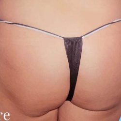 Buttock Augmentation Before & After Patient #2435