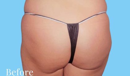 Buttock Augmentation Before & After Patient #2435
