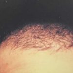 Hair Restoration Before & After Patient #2781