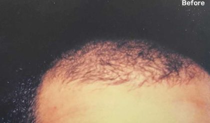 Hair Restoration Before & After Patient #2781