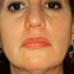 Liposuction Before & After Patient #2864