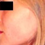 Rhinoplasty Before & After Patient #2988