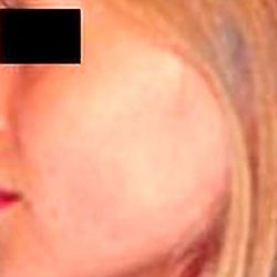 Rhinoplasty Before & After Patient #2988