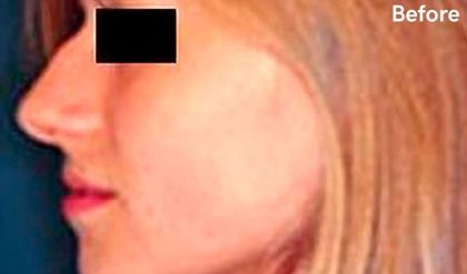 Rhinoplasty Before & After Patient #2988