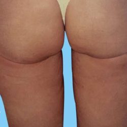 Buttock Augmentation Before & After Patient #2423