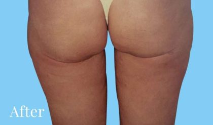 Buttock Augmentation Before & After Patient #2423