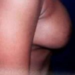 Breast Augmentation Before & After Patient #2230