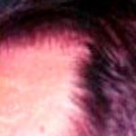Hair Restoration Before & After Patient #2772