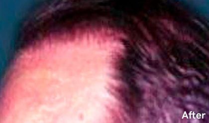 Hair Restoration Before & After Patient #2772