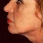 Liposuction Before & After Patient #2855