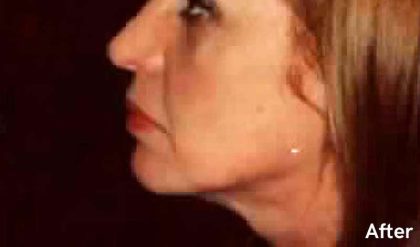 Liposuction Before & After Patient #2855