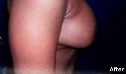 Breast Augmentation Before & After Patient #2230