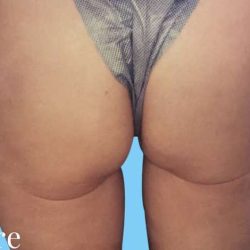 Buttock Augmentation Before & After Patient #2423