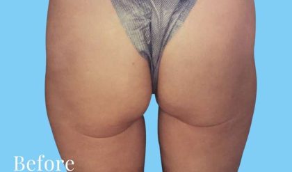 Buttock Augmentation Before & After Patient #2423