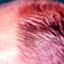 Hair Restoration Before & After Patient #2772