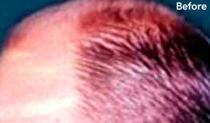 Hair Restoration Before & After Patient #2772