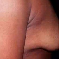 Breast Augmentation Before & After Patient #2230