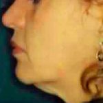 Liposuction Before & After Patient #2855