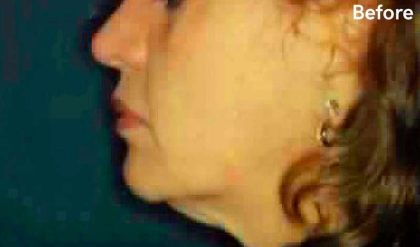 Liposuction Before & After Patient #2855