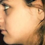 Rhinoplasty Before & After Patient #2979