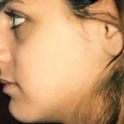Rhinoplasty Before & After Patient #2979