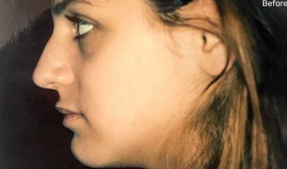 Rhinoplasty Before & After Patient #2979