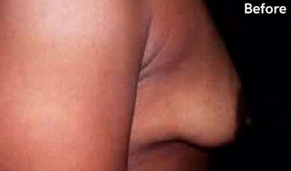 Breast Augmentation Before & After Patient #2230