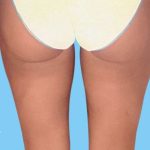 Liposuction Before & After Patient #2447